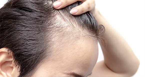 person examining hairline showing thinning areas suggesting hair loss treatment options for both men and women
