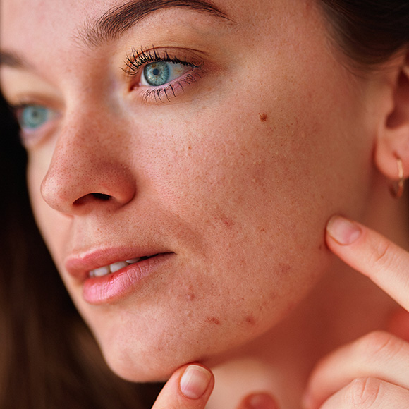 close up of a woman gently touching her face examining her skin with acne and freckles emphasizing skin care routines for clarity and improvement