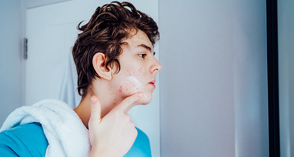 teen boy examining his skin with acne in bathroom mirror skincare routine 2 products for acne treatment